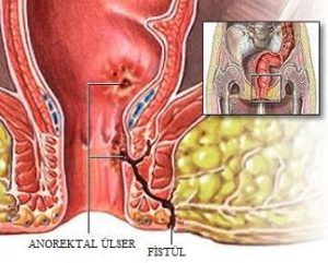 ANOREKTAL FİSTÜL (Anal Fistül, Perianal Fistül)